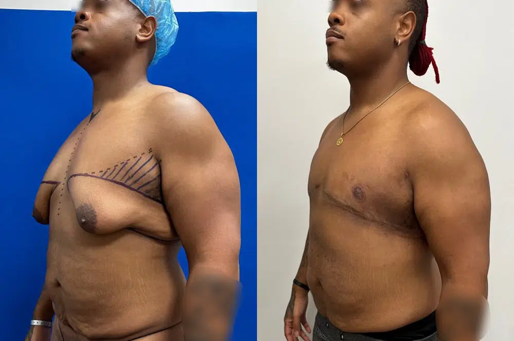 Gyno Surgery Before and After