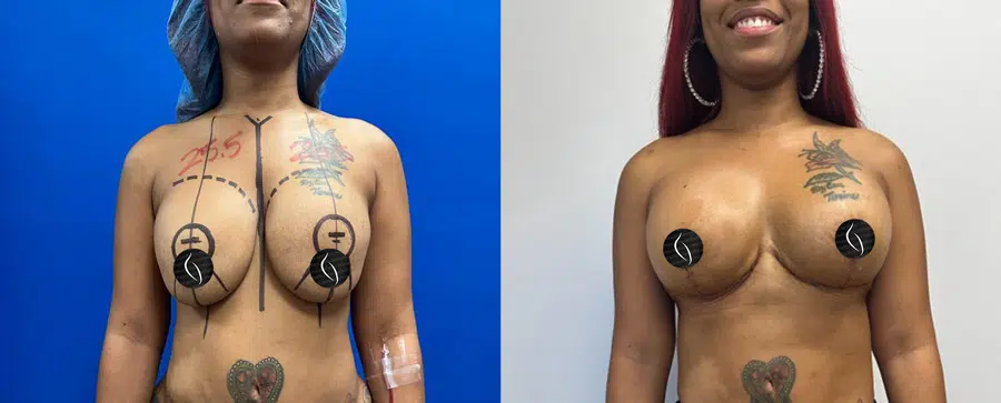 Breast lift with implants before and after