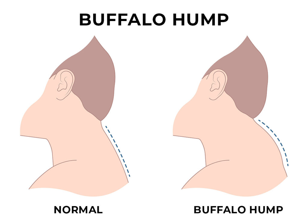 Normal Neck Versus Buffalo Hump Neck