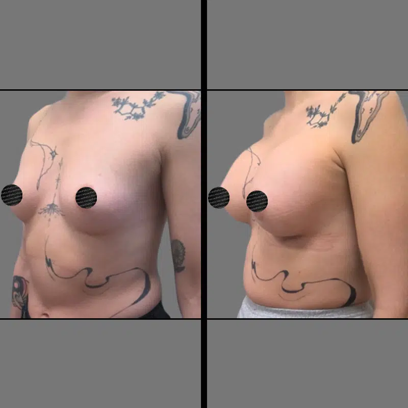 Dr. Banks Breast Procedures - Before & After 1