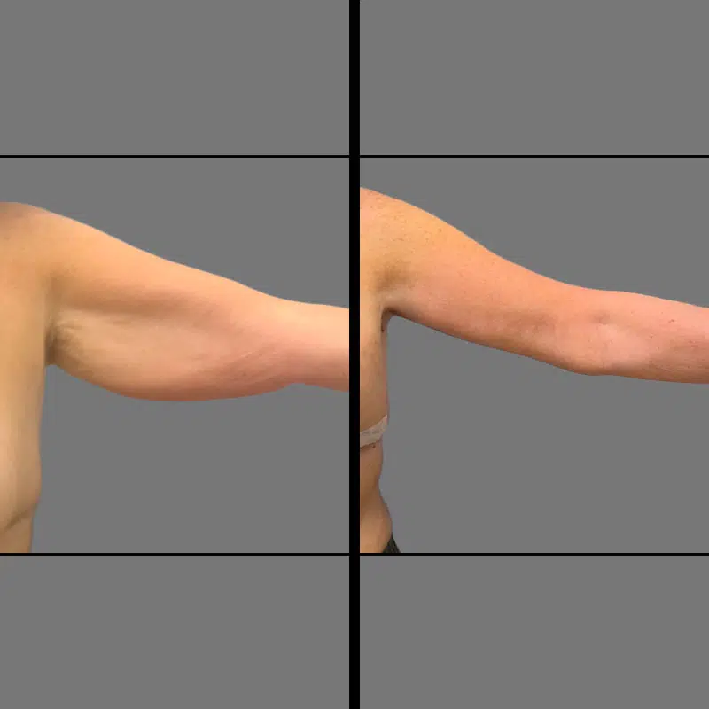 Dr. Banks Arm Lift - Before & After 1