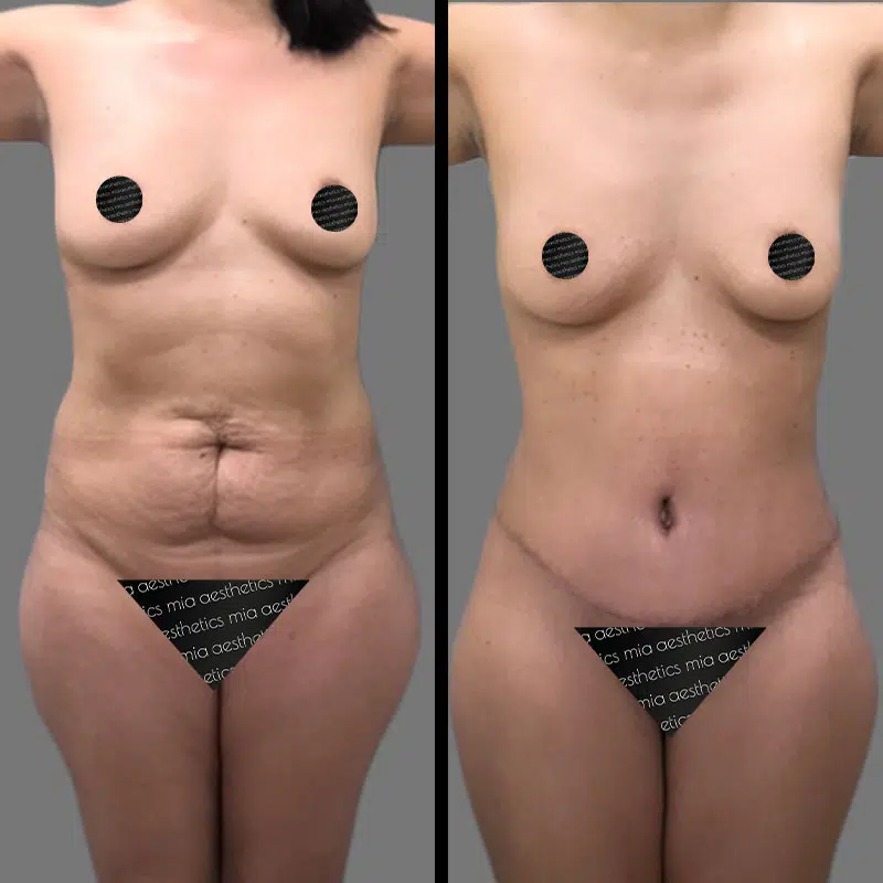 Dr. Banks Tummy Tuck - Before & After 1