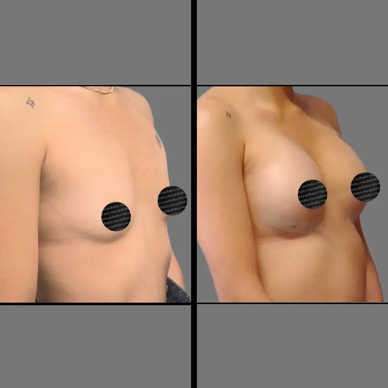 Dr. Charepoo BBL - Before & After 1