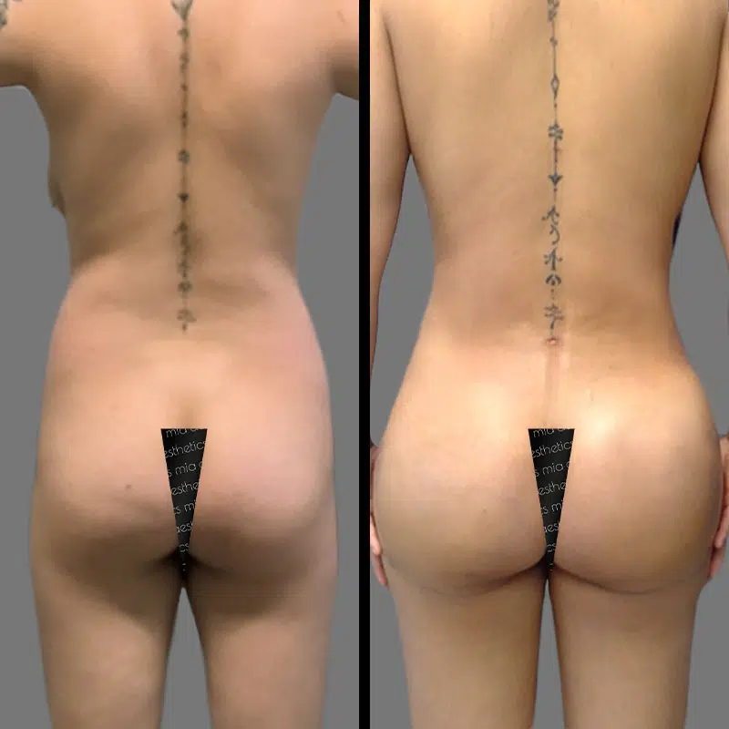 Dr. Caputy BBL - Before & After 1