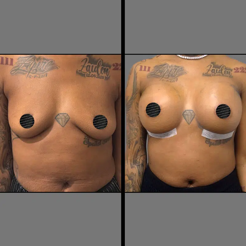 Dr. Poser Breast Procedure - Before & After 2