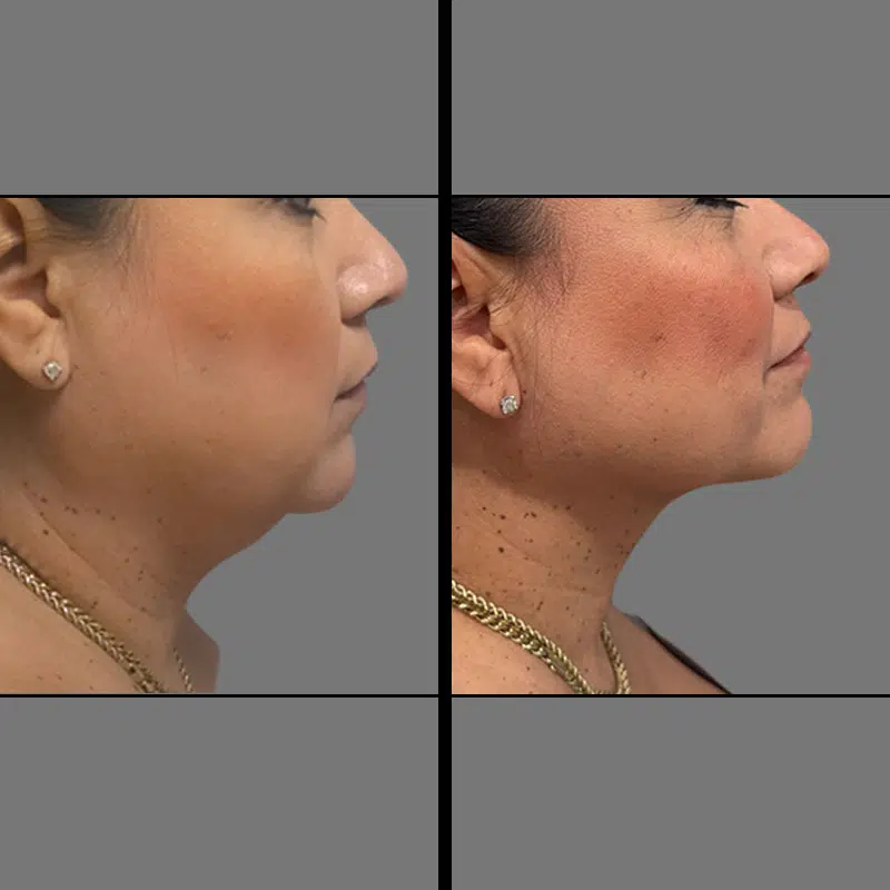 Dr. Vuu Chin Lipo - Before & After 1