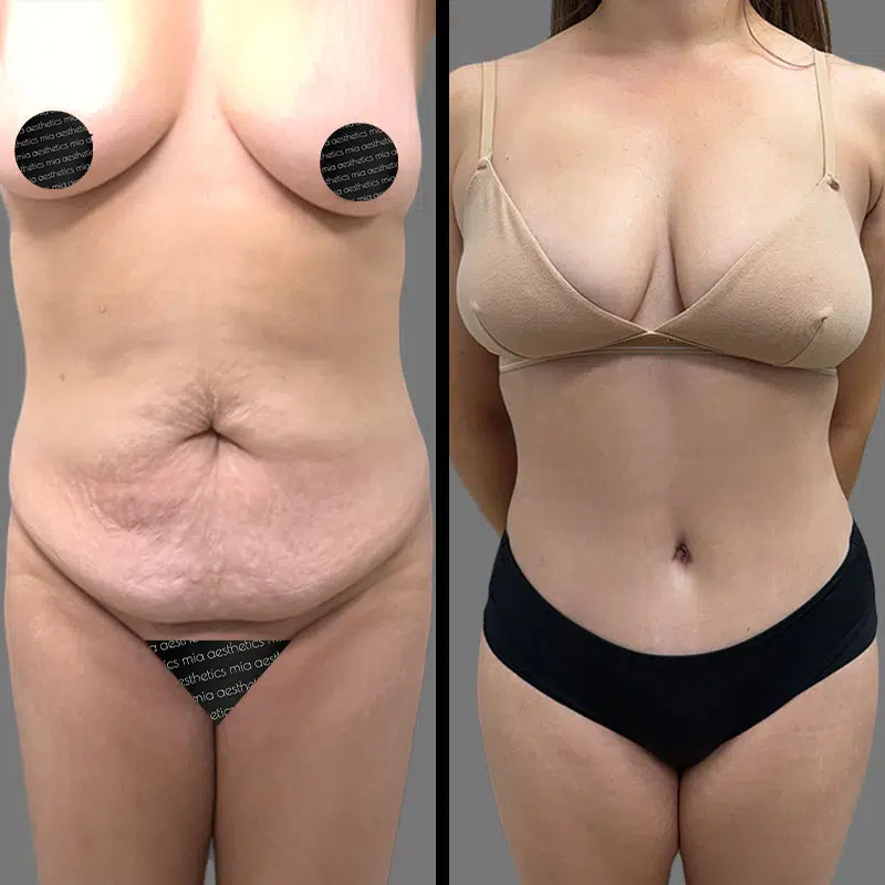 Dr. Vuu Tummy Tuck - Before & After 1