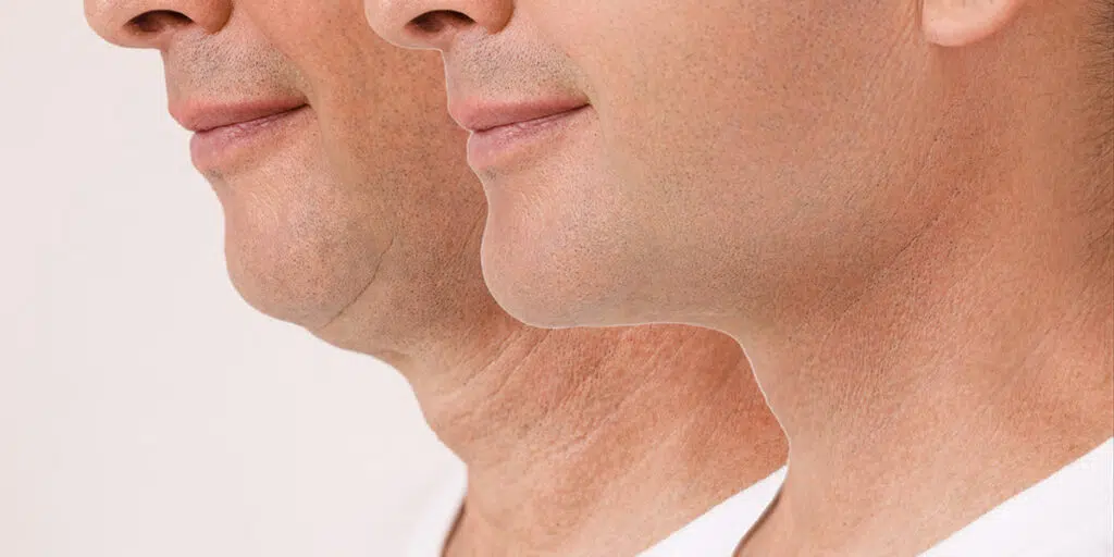 Neck Lift for men