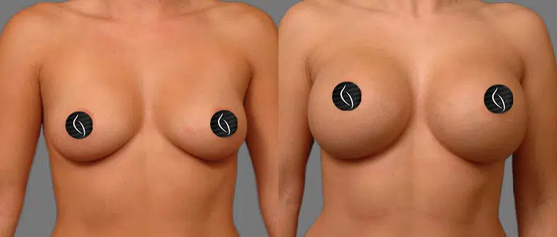 Woman Before & After Breast Augmentation