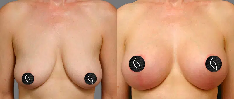 Woman Before & After Breast Lift