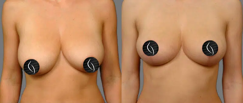 Woman Before & After Breast Lift