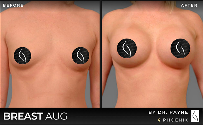Dr. Payne Breast Augmentation - Before & After 1