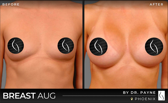 Dr. Payne Breast Augmentation - Before & After 2