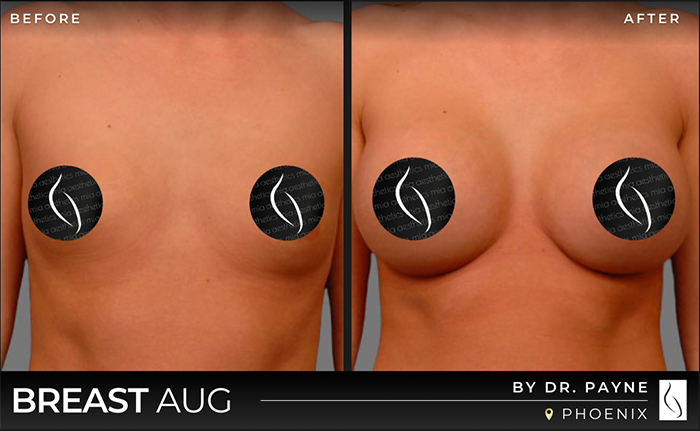Dr. Payne Breast Augmentation - Before & After 3