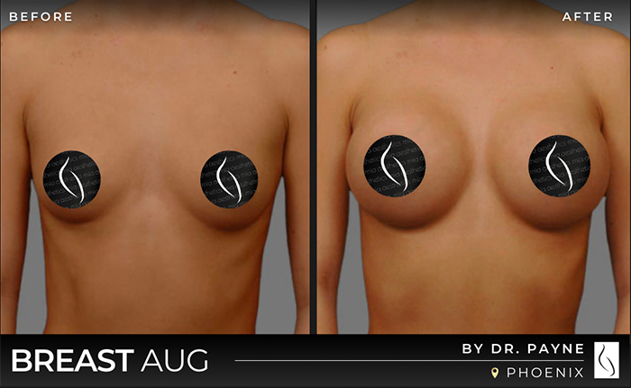 Dr. Payne Breast Augmentation - Before & After 4