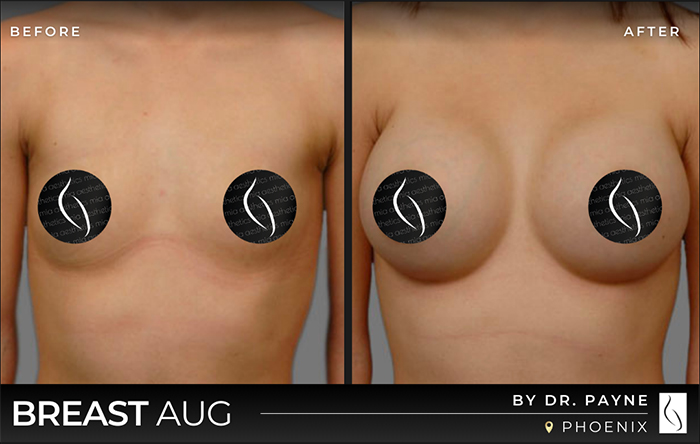 Dr. Payne Breast Augmentation - Before & After 5