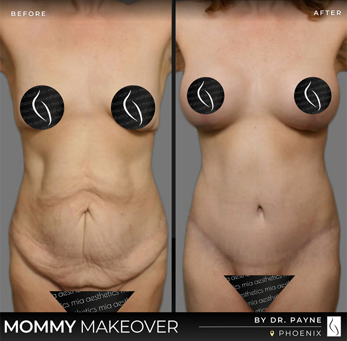 Dr. Payne Mommy Makeover - Before & After 1