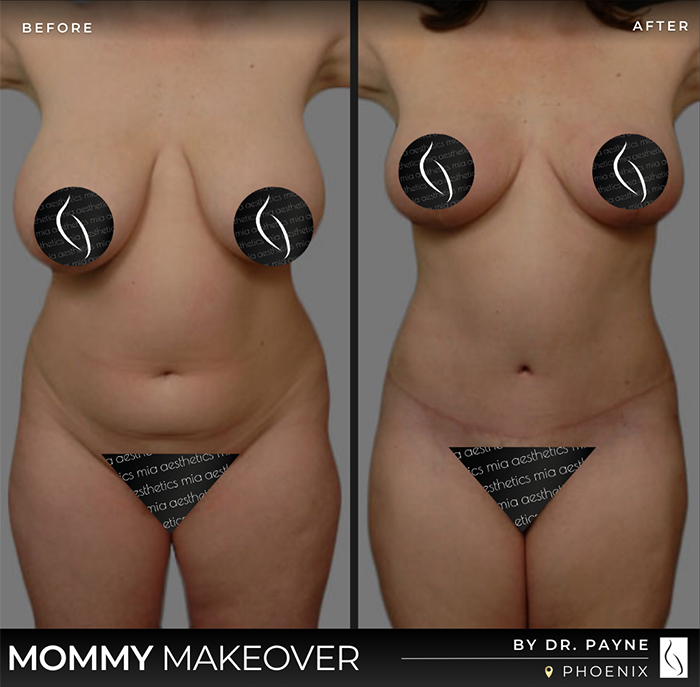 Dr. Payne Mommy Makeover - Before & After 2