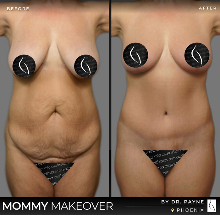 Dr. Payne Mommy Makeover - Before & After 3