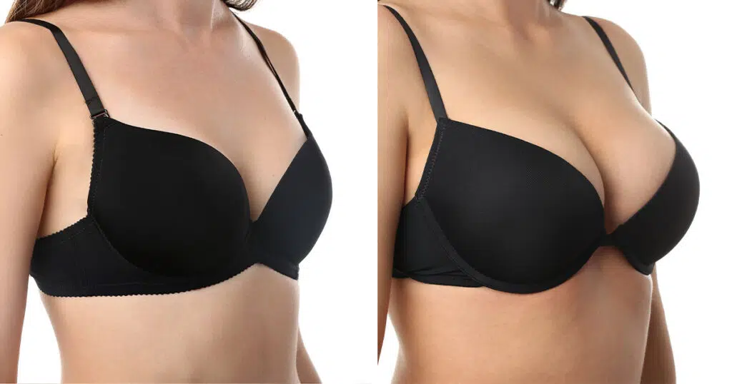Under-the-Muscle Breast Augmentation