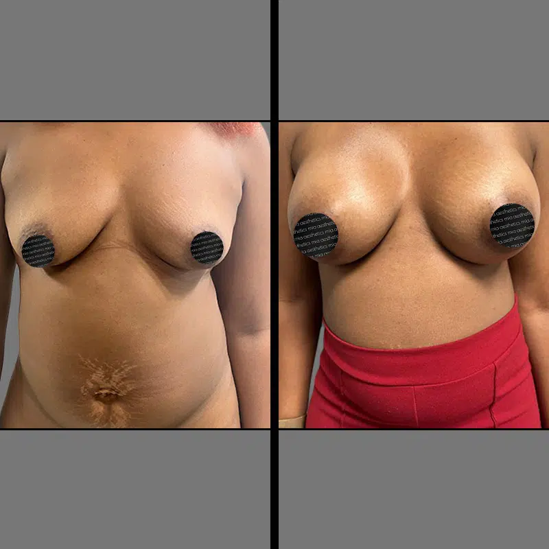 Dr. Cooper Breast Augmentation - Before & After 2