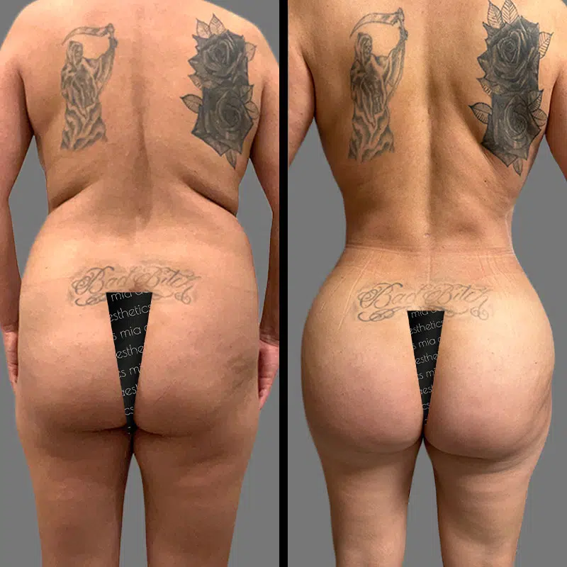 Dr. Cooper BBL - Before & After 1