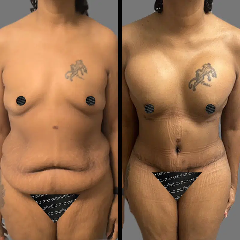 Dr. Cooper Mommy Makeover - Before & After 1