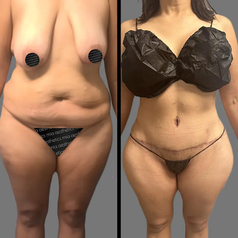 Dr. Cooper Mommy Makeover - Before & After 2