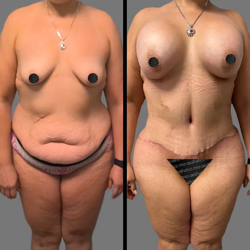 Dr. Cooper Mommy Makeover - Before & After 4