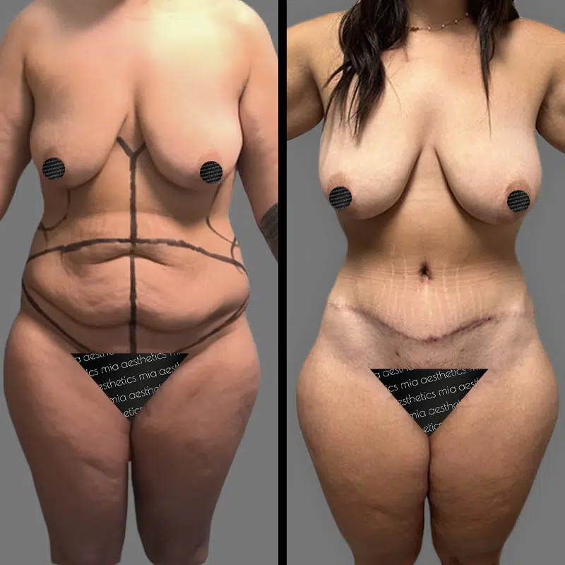 Dr. Cooper Tummy Tuck - Before & After 1