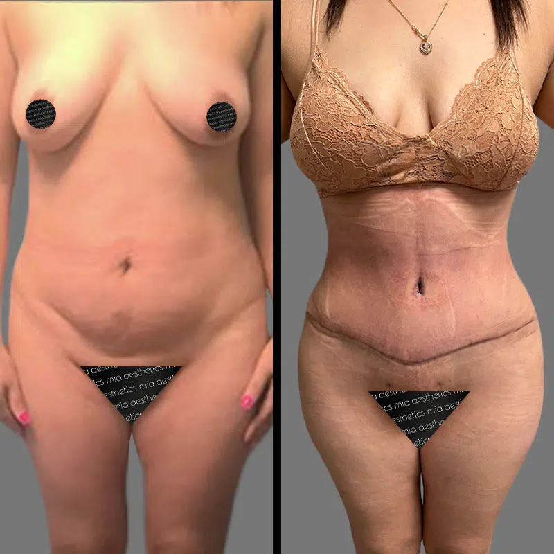 Dr. Cooper Tummy Tuck - Before & After 2