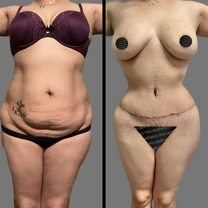 Dr. Cooper Tummy Tuck - Before & After 3