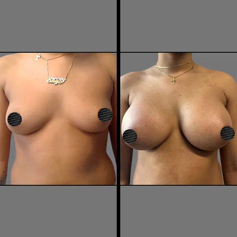 Dr. Elbayer Breast Augmentation - Before & After 3