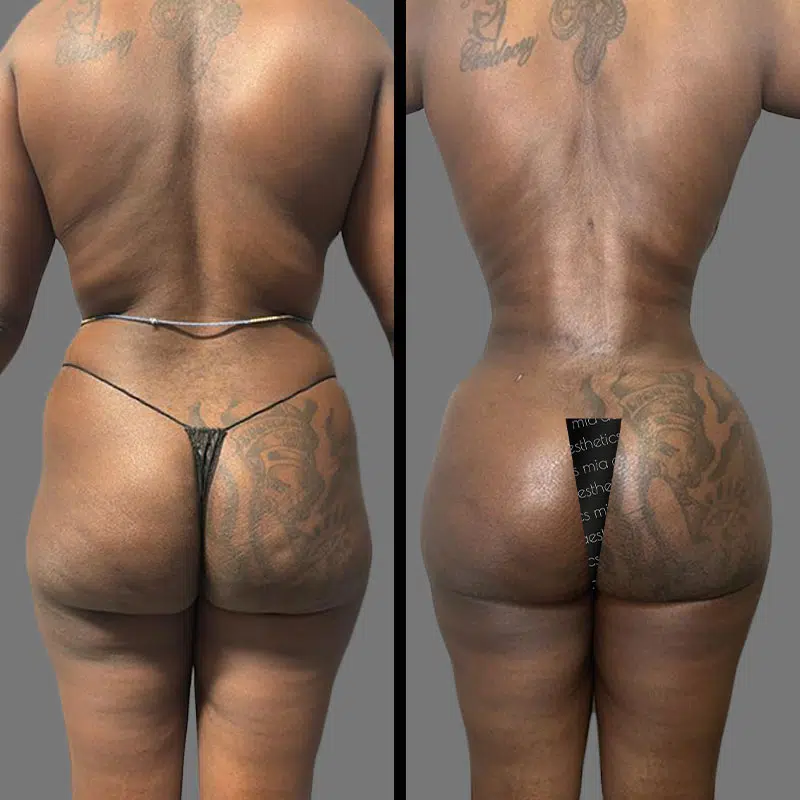 Dr. Elbayer BBL - Before & After 2