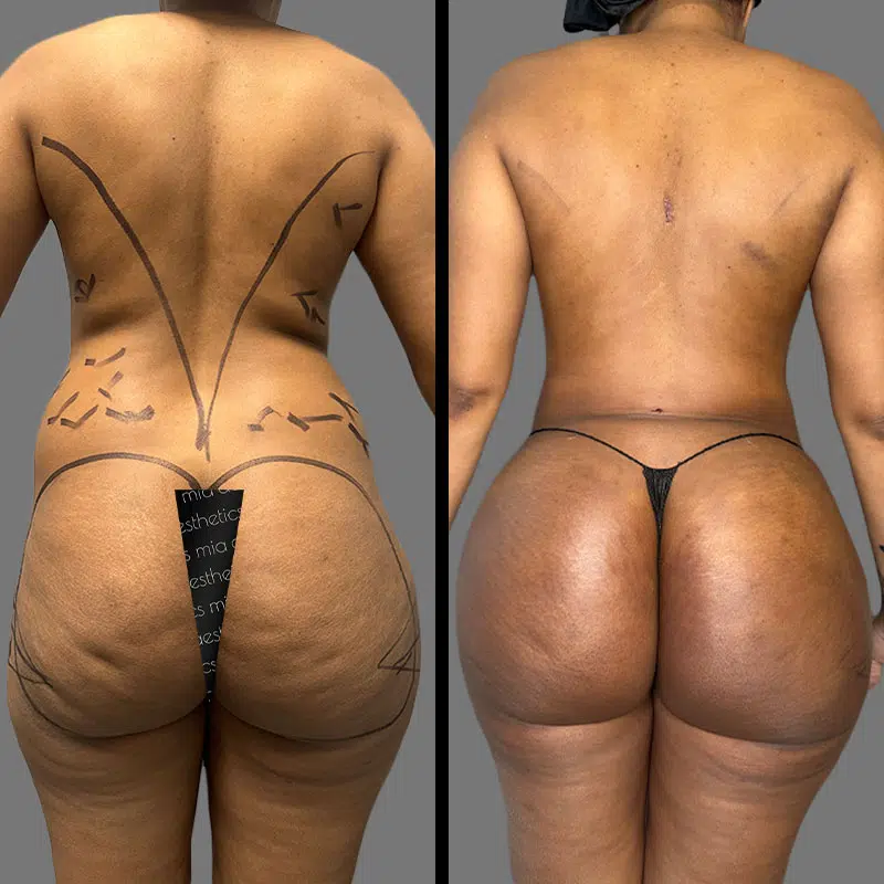 Dr. Elbayer BBL - Before & After 3