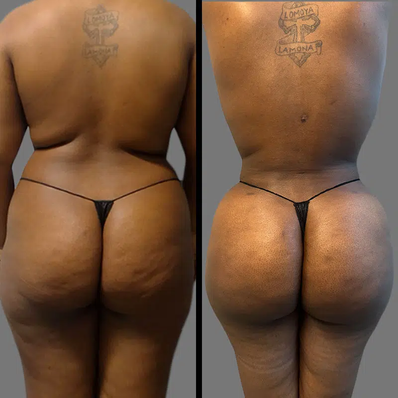 Dr. Elbayer BBL - Before & After 4
