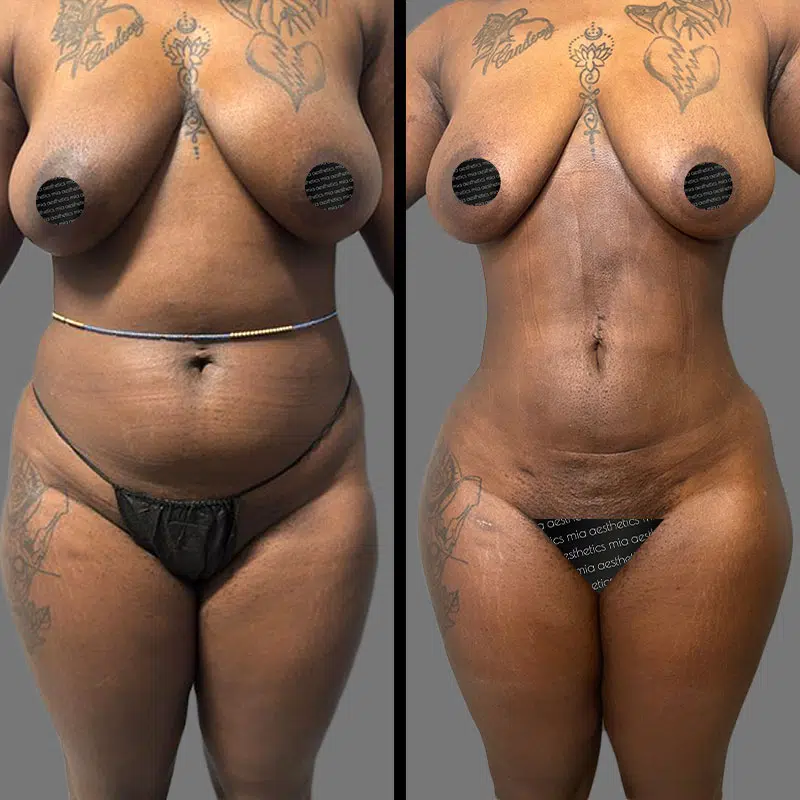 Dr. Elbayer Lipo 360 - Before & After 3