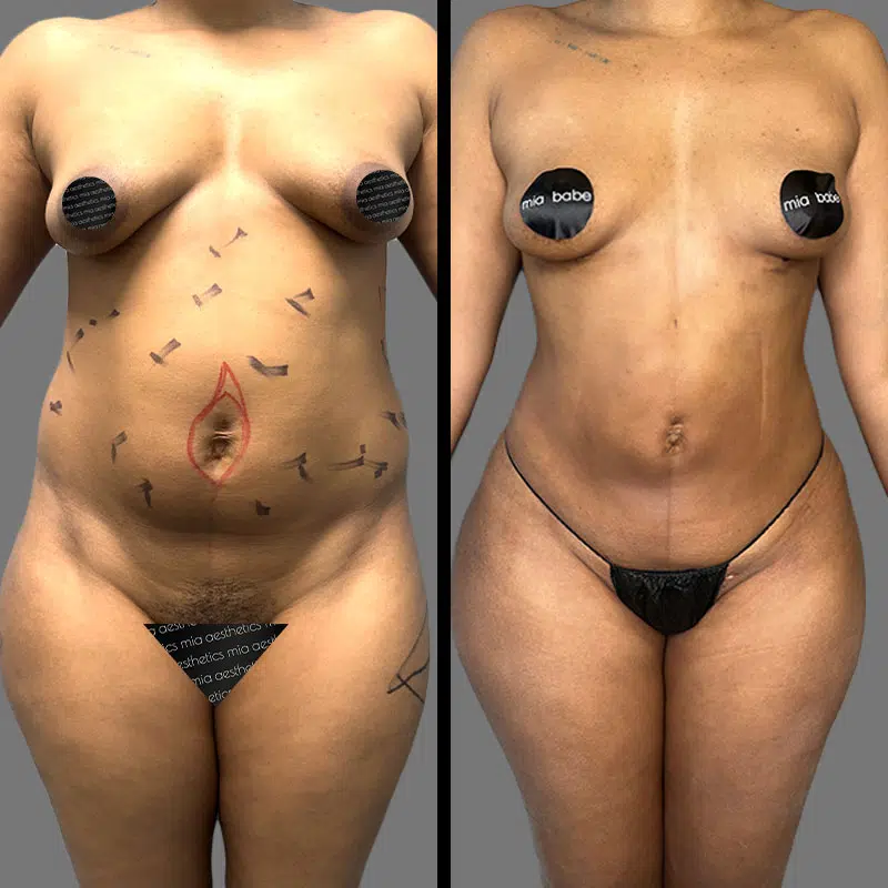 Dr. Elbayer Lipo 360 - Before & After 4