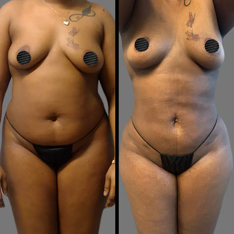 Dr. Elbayer Lipo 360 - Before & After 5