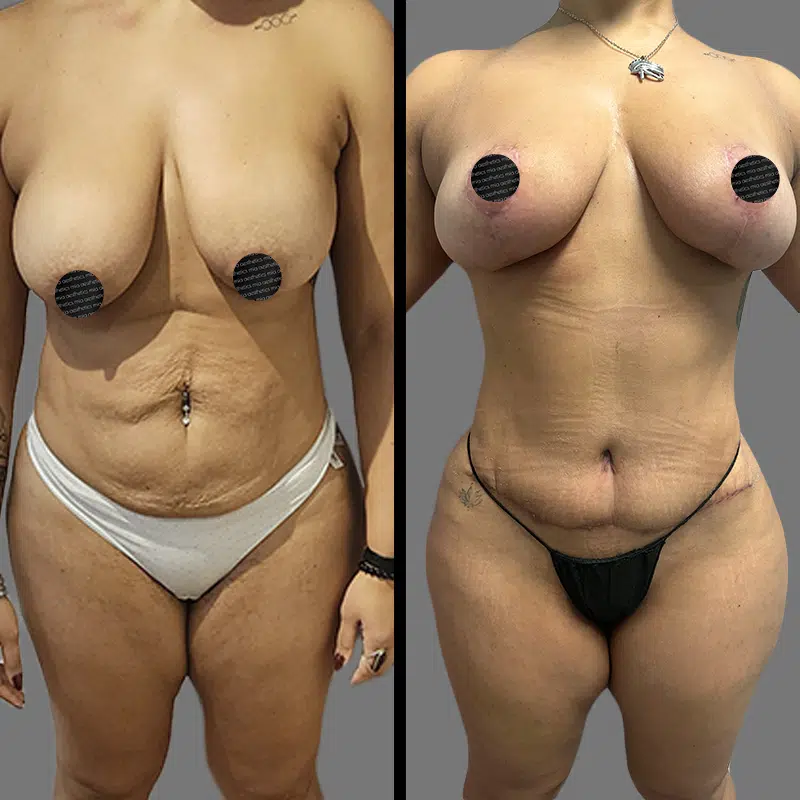 Dr. Elbayer Mommy Makeover - Before & After 1