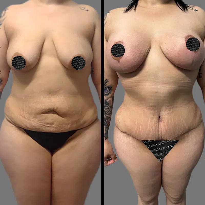 Dr. Elbayer Mommy Makeover - Before & After 2