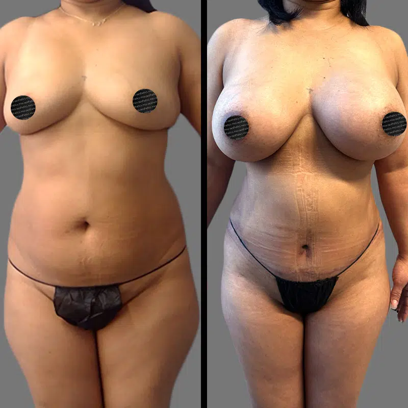 Dr. Elbayer Mommy Makeover - Before & After 3