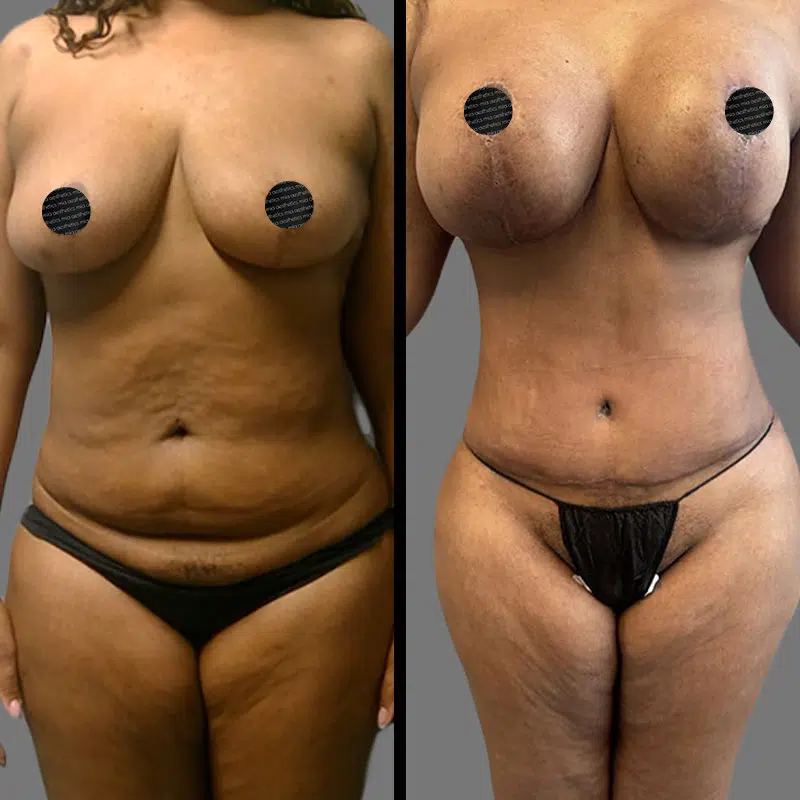 Dr. Elbayer Mommy Makeover - Before & After 4