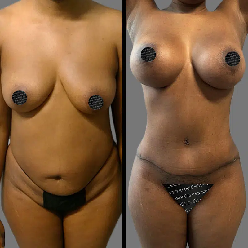 Dr. Elbayer Mommy Makeover - Before & After 5
