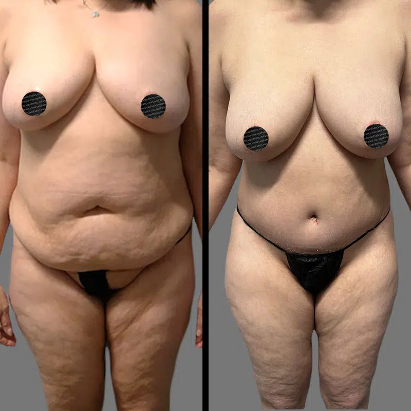 Dr. Elbayer Tummy Tuck - Before & After 1