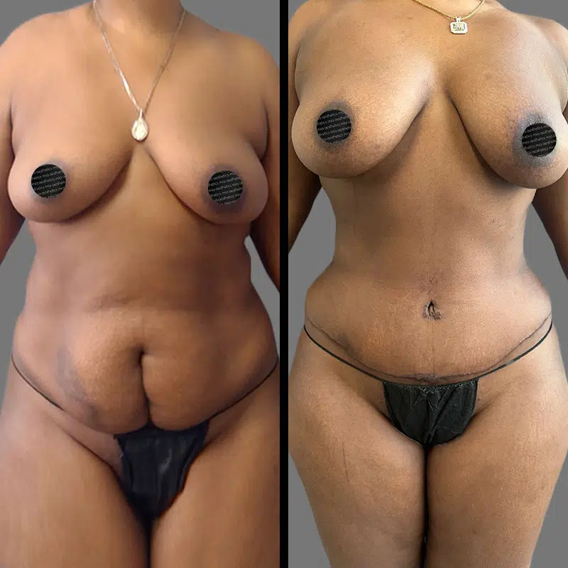 Dr. Elbayer Tummy Tuck - Before & After 2