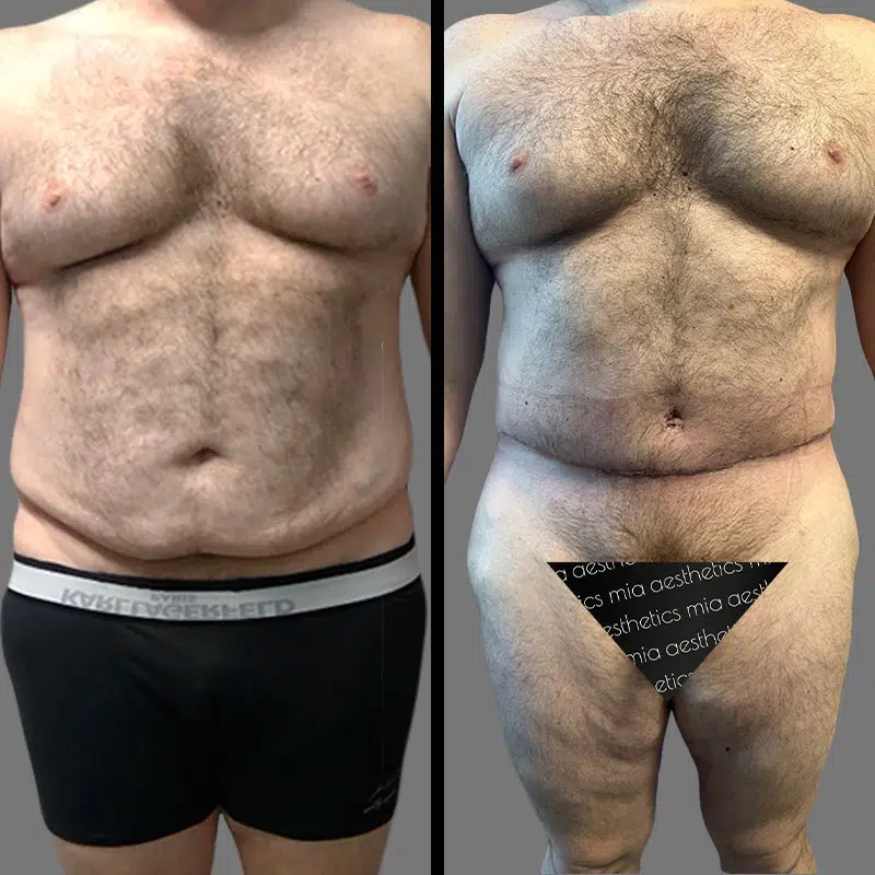 Dr. Elbayer Tummy Tuck - Before & After 3