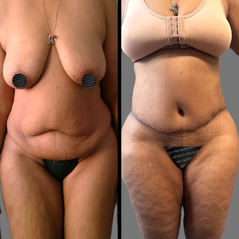 Dr. Elbayer Tummy Tuck - Before & After 4
