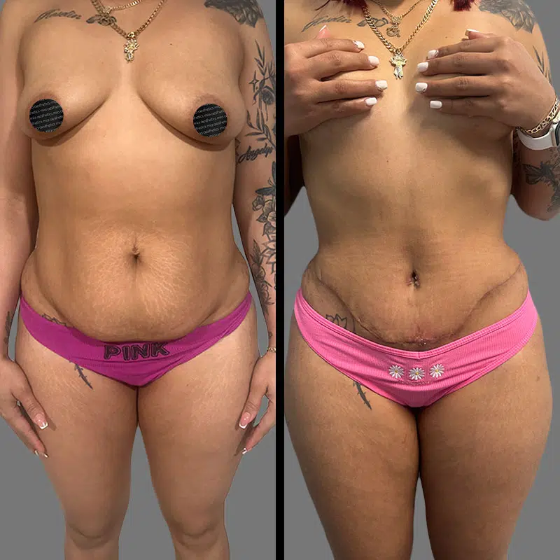 Dr. Elbayer Tummy Tuck - Before & After 5