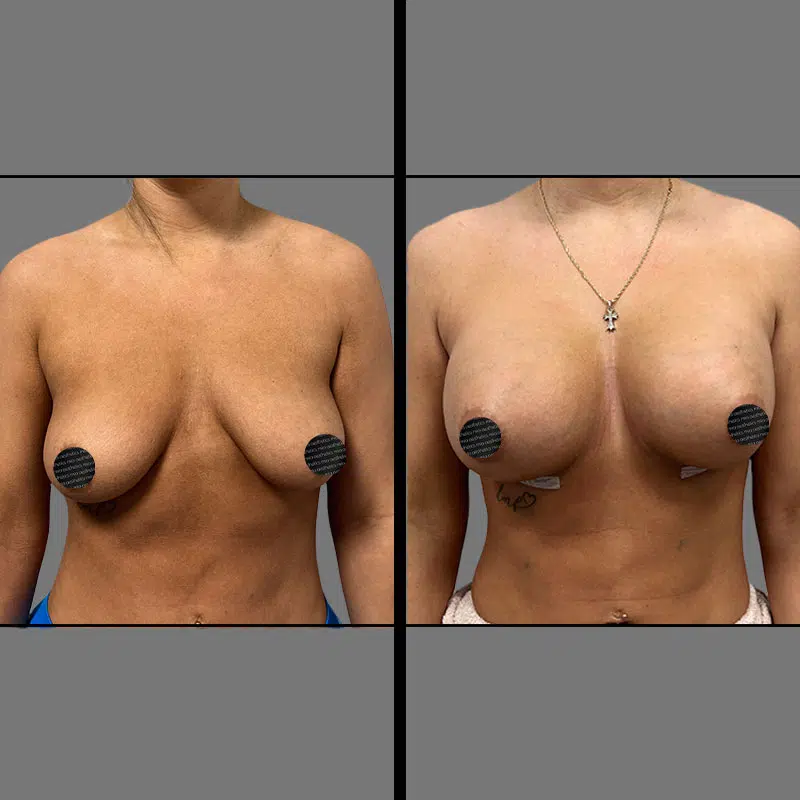 Dr. Giorgis Breast Augmentation - Before & After 1